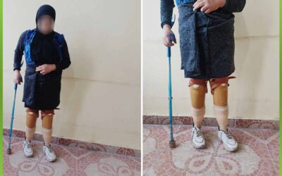 الافريقية تساعد فاقدين الاطراف بأطراف صناعية
