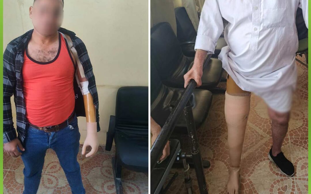 الافريقية توفر اطراف صناعية للحالات التي فقدت اطرافها