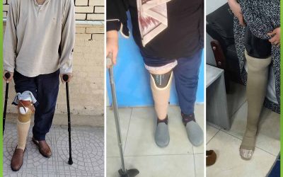 الأفريقية توفر أطرافًا صناعية لعدد من الحالات