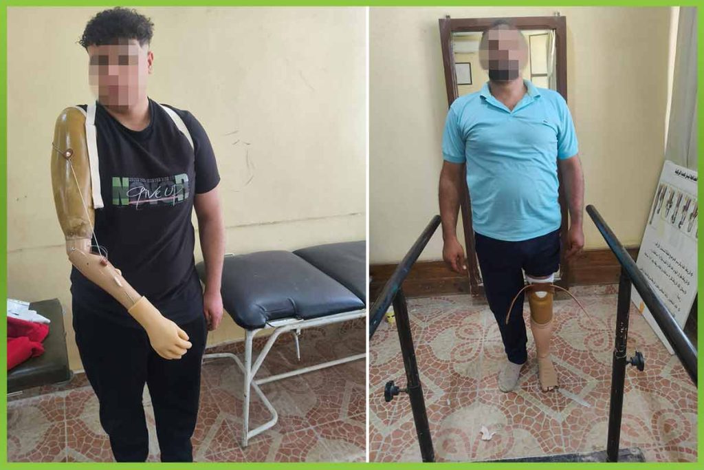 تركيب اطراف صناعية لحالات غير قادرة